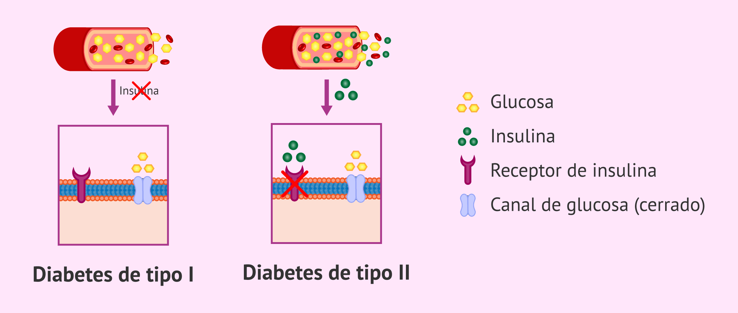 Tipos de diabetes (visión general)